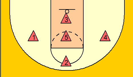 1-3-1 zone defense